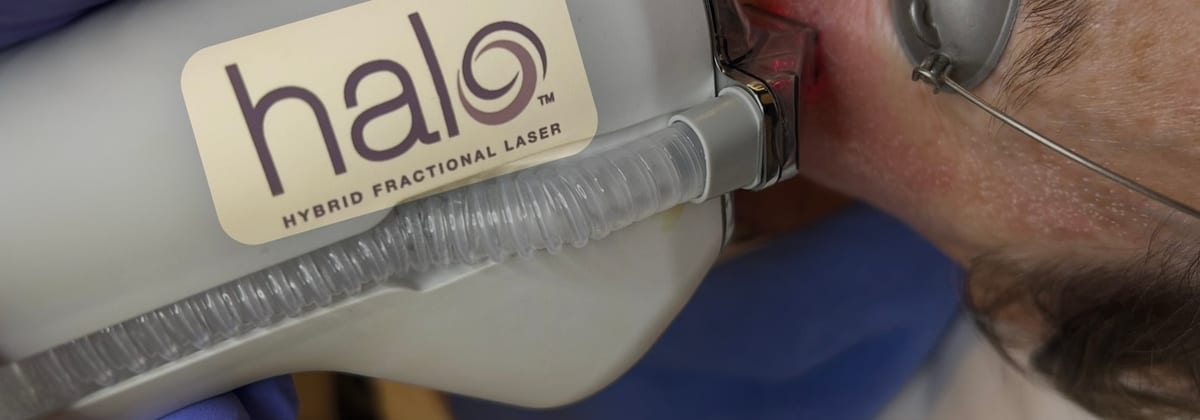 Laser treatment results at Clinique en Beauté