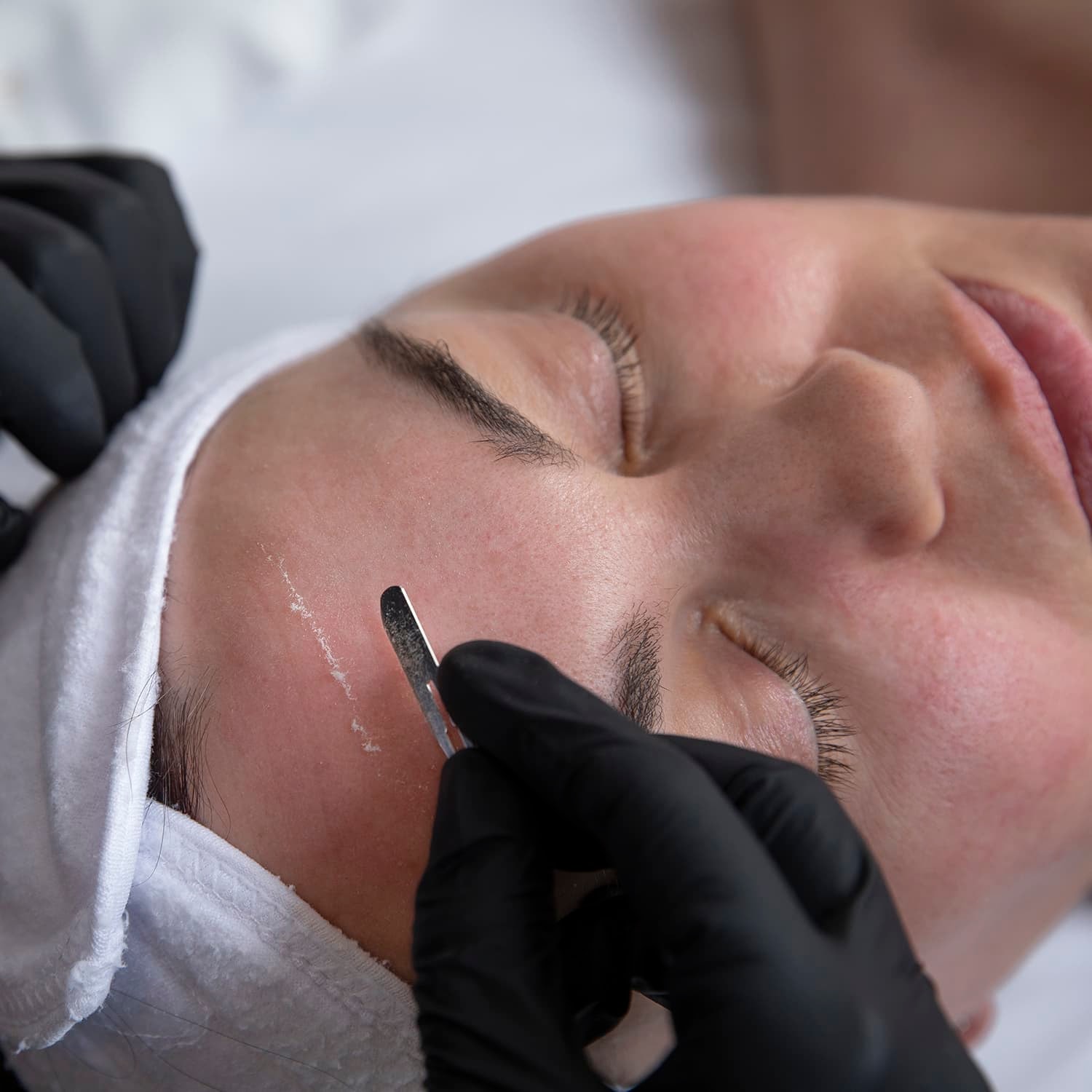 Chemical Peels & Skincare