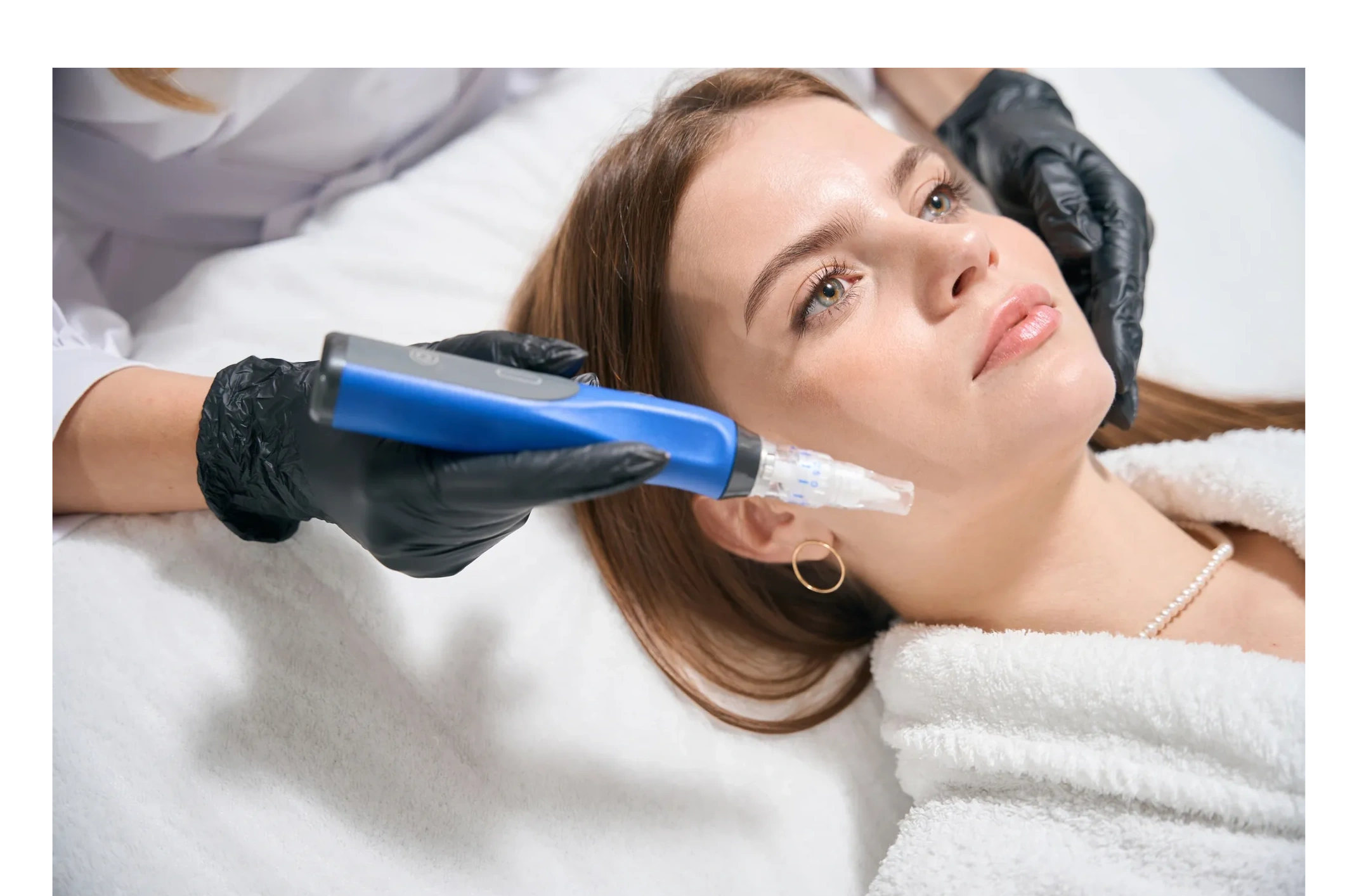 Microneedling